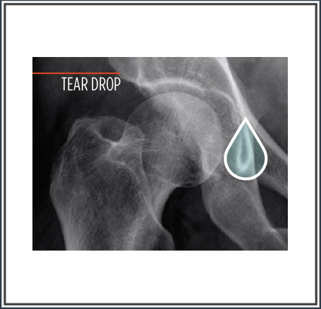 hipgrid-9-inch-teardrop-target-455x439